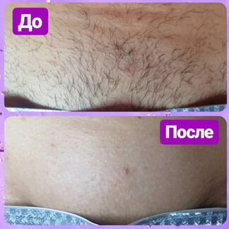 Шугаринг (сахарная депиляция) на дому